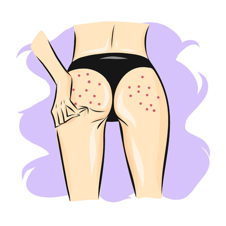 Sketch line art woman or girl body with acne skin problem with hand on ass. Fashion illustration for poster, banner, logo, icon, printing of undewear shop, intimate goods for adult, sport industry.のイラスト素材
