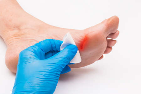 Doctors hand in a protective medical glove applies a cotton pad to the wound on the foot, womans leg on a white background, close-upの写真素材