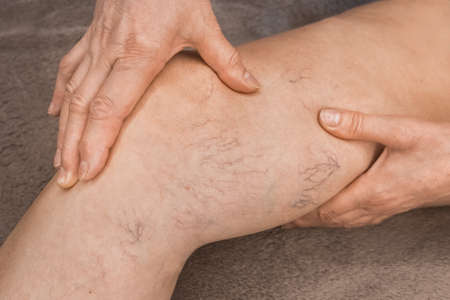 The hands of an elderly woman shows on varicose veins, sick female legs.の写真素材
