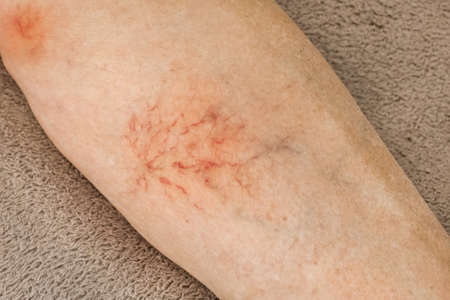 Varicose veins, sore female leg, venous disease.の写真素材