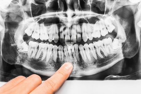 The dentist's hand points the finger at the medical image of the mouth and examines the slight...