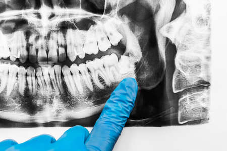 A doctor's hand in a protective medical glove points with a finger at the growth of wisdom teeth in the lower jaw on an X-ray image of the oral cavity, close-up.の写真素材