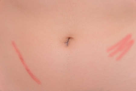 Body abdomen skin scar after removal of appendicitis surgery consequences of surgery, close-up.の写真素材