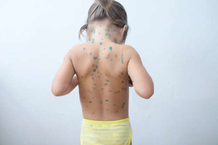 Child back with chickenpox. Sick little girl  with varicells making eruption on skin. Long home quarantine, then having immunity for ever.の写真素材