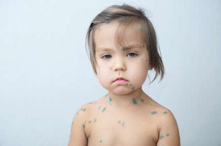 Child portrait with chickenpox. Sick little girl  with varicells making eruption on skin. Long home quarantine, then having immunity for ever.の写真素材
