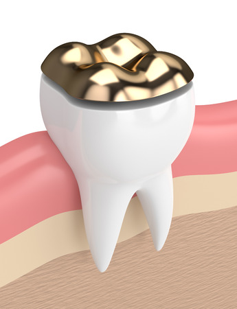 3d render of teeth with dental onlay filling in gums の写真素材