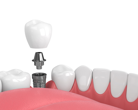 3d render of jaw with teeth and dental premolar implant over white backgroundの写真素材