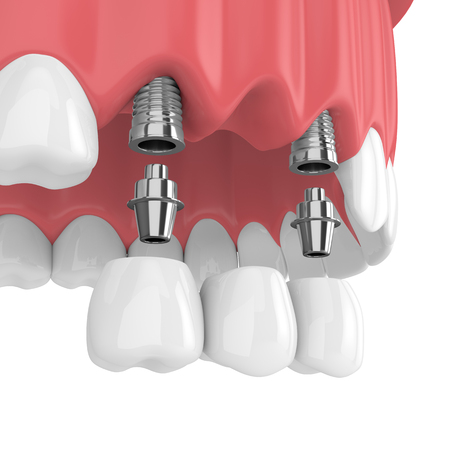 3d render of implants with dental bridge in upper jaw  isolated over white backgroundの写真素材