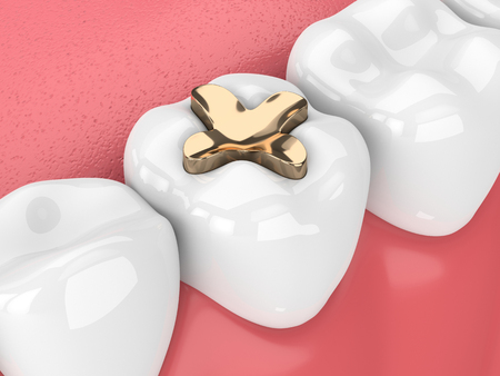 3d render of teeth with dental inlay golden filling over white backgroundの写真素材