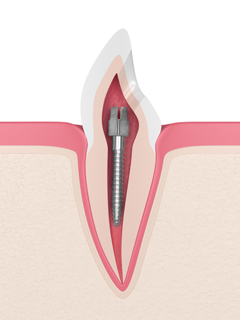 3d render of incisor tooth with dental metal post in gums. Endodontic treatment conceptの写真素材