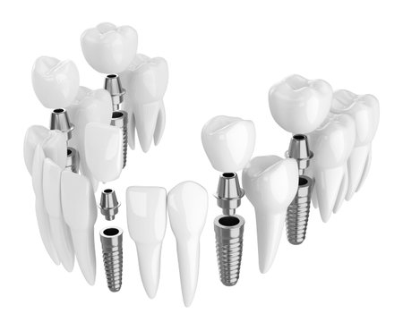 3d render of toothing with dental implants isolated over white background