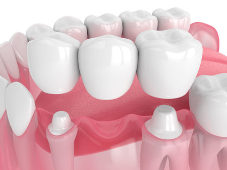 3d render of jaw with dental bridge  over white background