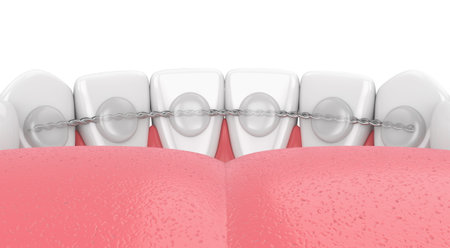 3d render of dental bonded retainer on lower jaw over white background