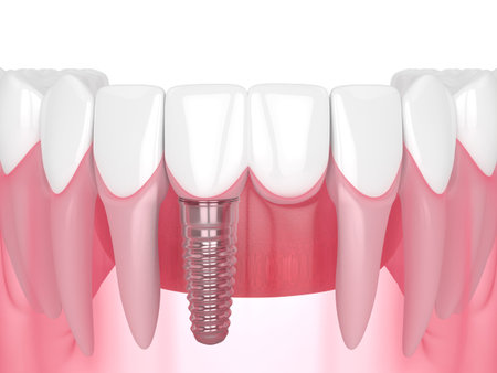 3d render of jaw with dental incisor cantilever bridge supported by implant