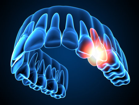 3d render of jaw x-ray with throbbing premolar toothache.