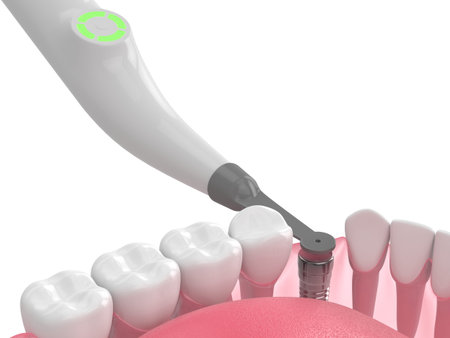 3d render of jaw with buried healing cap and smart implant detector over white background