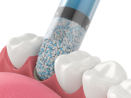 3D render of dental bone grafting with dental bone biomaterial application over white background....