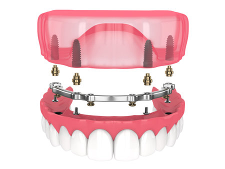 Bar retained removable overdenture installation supported by implants over white backgroud
