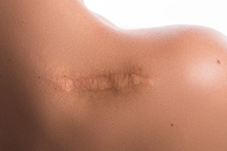 Close up of female shoulder with a scar