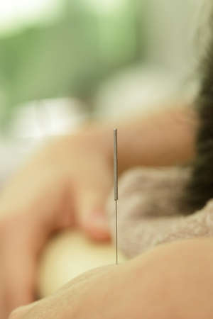 Alternative medicine. Close-up of female arm with steel needles during procedure of acupuncture therapy.の写真素材