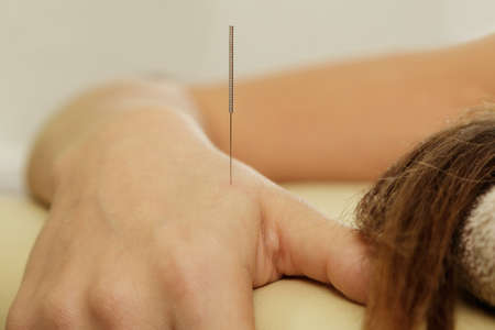 Alternative medicine. Close-up of female arm with steel needles during procedure of acupuncture therapy.の写真素材