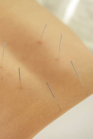 Alternative medicine. Close-up of female back with steel needles during procedure of acupuncture therapy.の写真素材