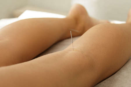 Alternative medicine. Close-up of female legs with steel needles during procedure of acupuncture therapy.の写真素材