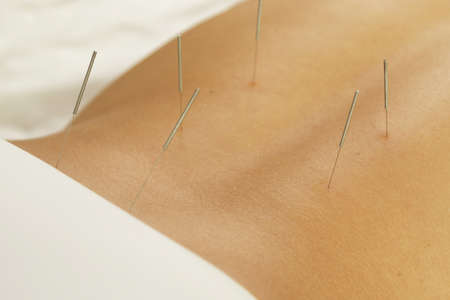 Alternative medicine. Close-up of female back with steel needles during procedure of acupuncture therapy.の写真素材