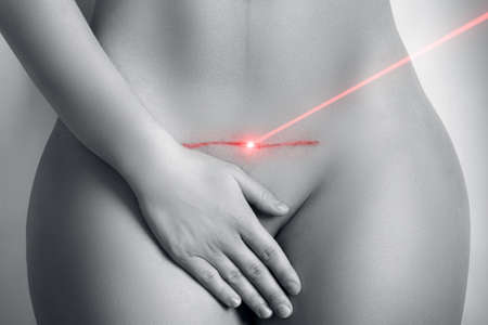 Laser scar removal after the C-section surgeryの写真素材