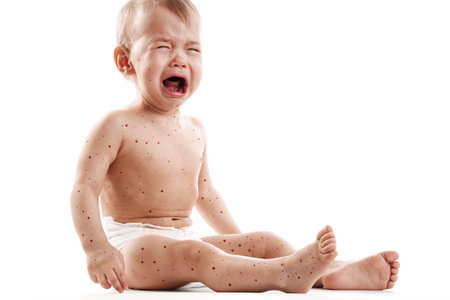 Baby boy with skin affected by blistering rash because of monkeypox or chickenpox on white...
