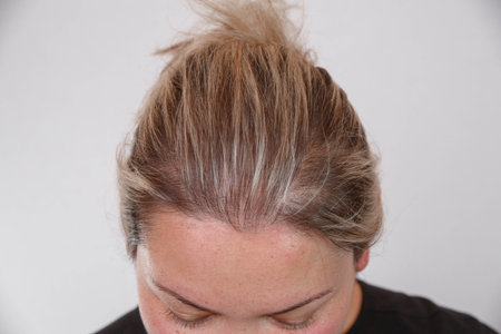38 year old Caucasian woman with spot alopecia, bald spot on her head