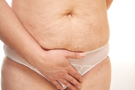 belly of a 40 year old woman with postpartum stretch marks close up