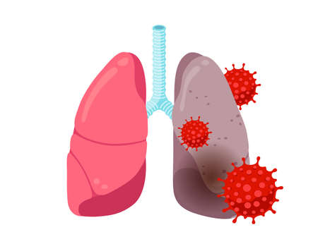 Healthy and sick unhealthy lungs with coronavirus infection disease. Human respiratory system internal organ with pneumonia. Infected COVID-19 lung disease vector eps illustration. Pandemic damageのイラスト素材