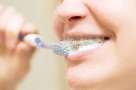 girl with braces brushing her teeth. close-up. healthy even teeth and orthodonticsの写真素材