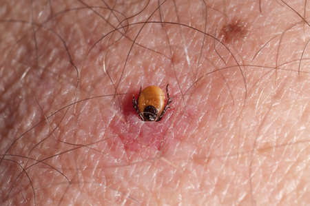 Tick burrowing in human skin