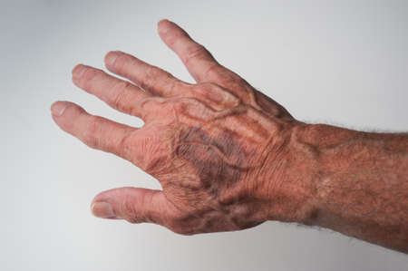 Bruises and Blood Spots Under the Skin that occur on older peopleの写真素材