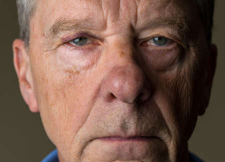 Close up of an elderly caucasian man with black eyeの写真素材