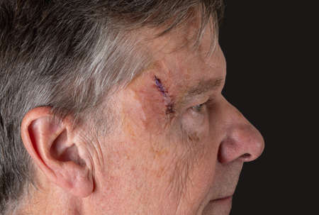 Senior adult male with stitches in the cut after surgery for removal of basal cell carcinoma caused...