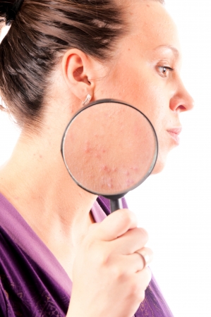 Acne problems close up isolated on white の写真素材