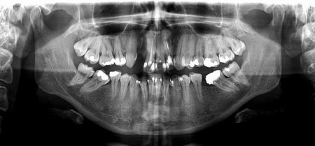 X ray of human mouth with teeth bones in black and whiteの写真素材