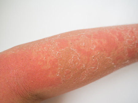 sunburn on the skin, severe tan on the armの写真素材