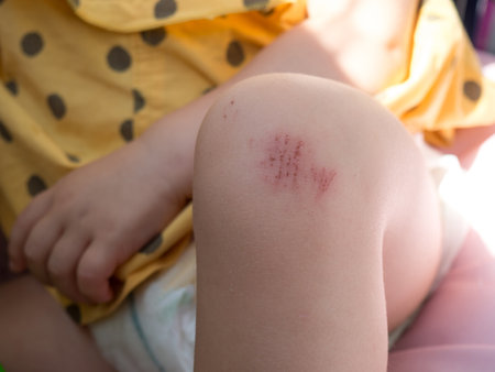 A wound on the child's leg. Fell on the road. abrasion on the knee of a child close upの写真素材