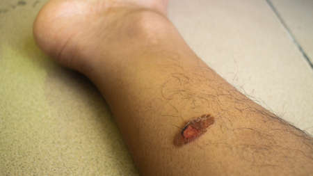 The wound on the leg is bleedingの写真素材