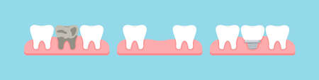 Dead tooth, lost stage and dental implant in gum isolated on blue background.