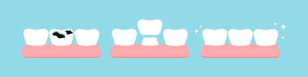 Teeth multiple caries, crown stage in gym before and after dental icon set isolated.のイラスト素材