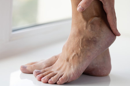 Woman gently touching her leg with large swollen veins.の写真素材