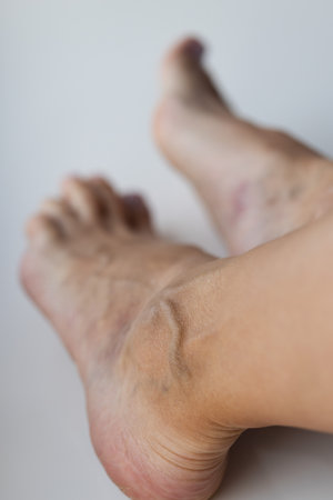 Large swollen vein on the foot. Varicose veins, closeup.の写真素材