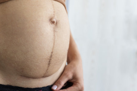 Closeup of woman belly with scar from cesarean section and dark weal after pregnancy.の写真素材
