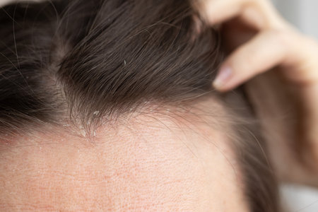 Closeup dandruff flakes on the scalp and on the hair.の写真素材