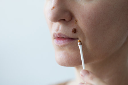 Beauty spot above the lips. Wound after removal a mole above the lips.の写真素材
